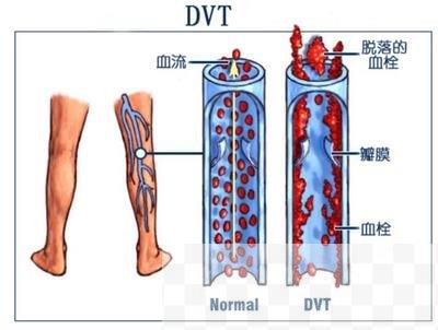 静脉血栓的预防以及它的治疗方法